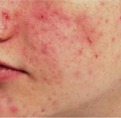 Excel V - Cutera Before & After Patient #1663